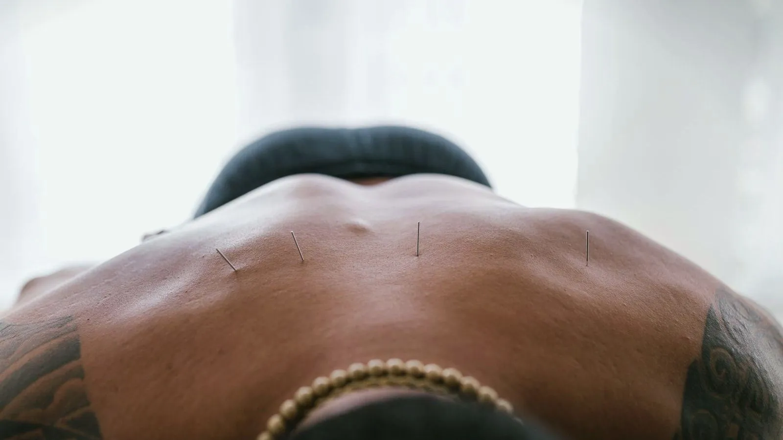 Acupuncture needles placed along the lower back of a person lying face down