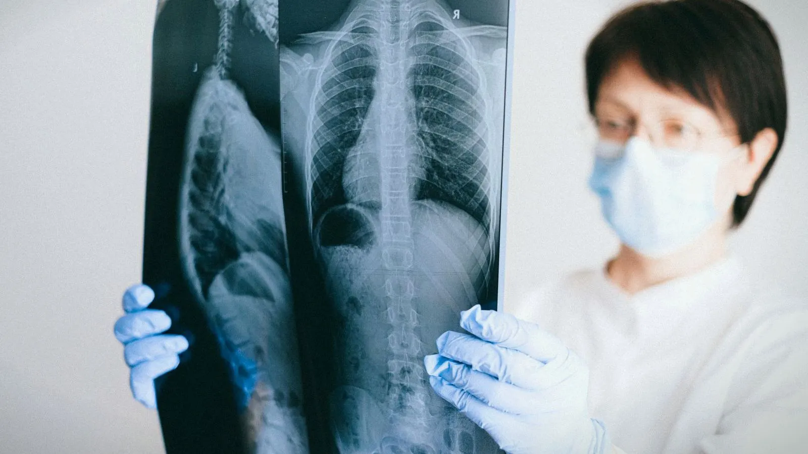 A clinician in a face mask, glasses and blue gloves holds up a chest X-ray film to examine it.