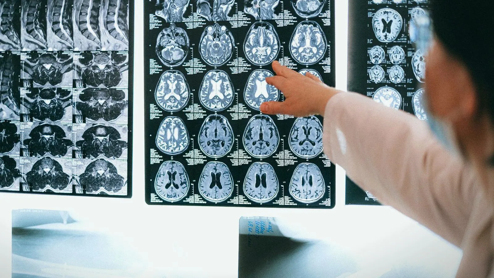 A clinician pointing at brain scans displayed on a lightbox