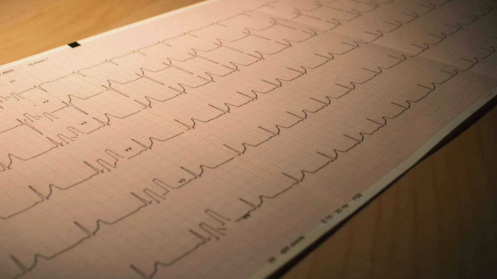 A paper electrocardiogram printout showing heart rhythm traces